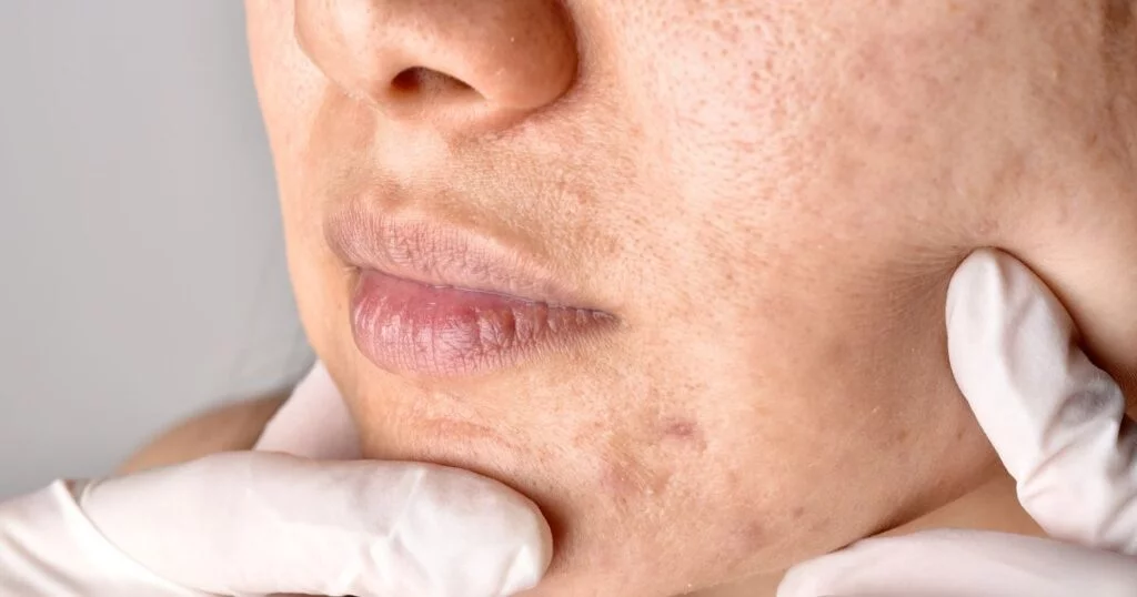 Key Benefits of Niacinamide for Skin Health